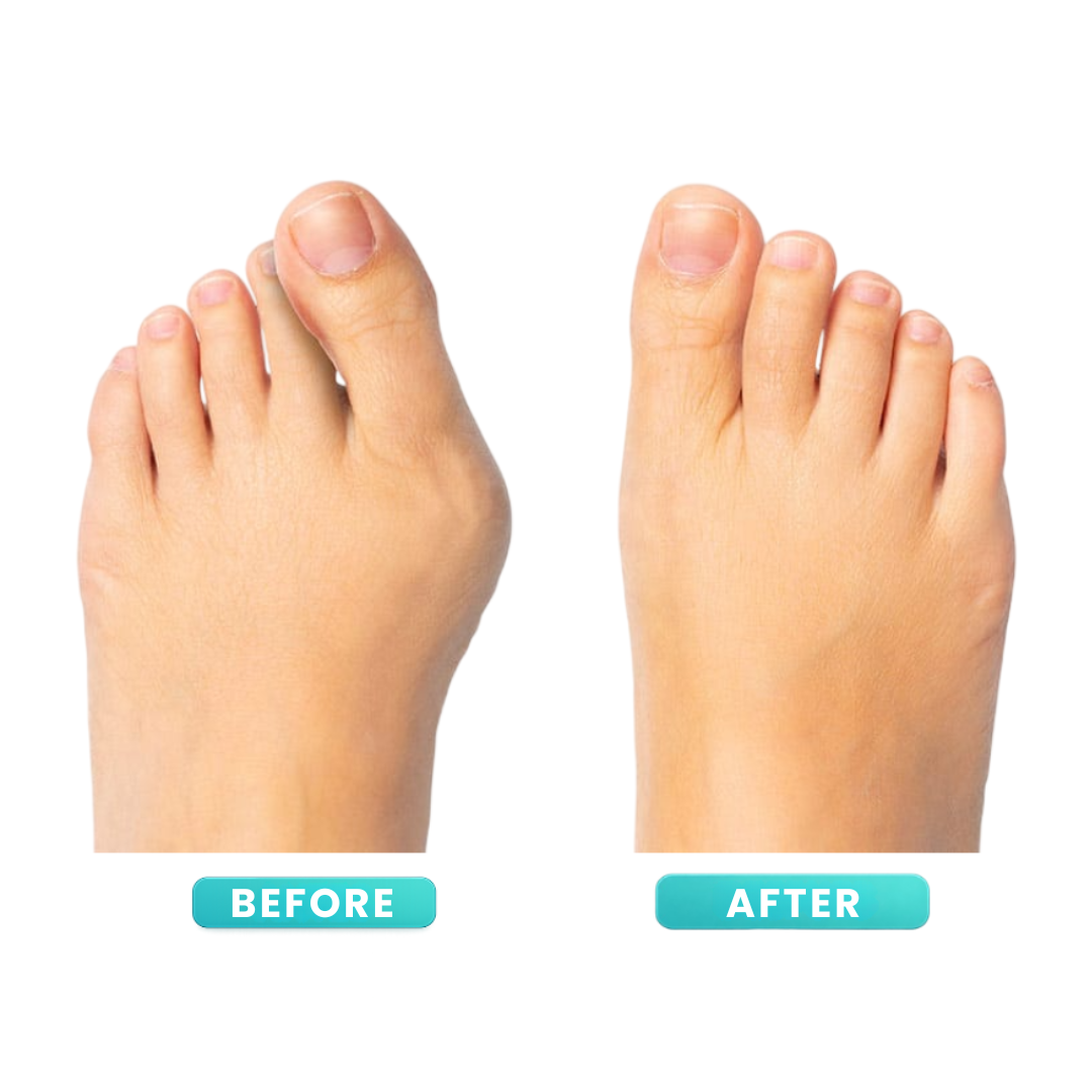 ToeAlign™ - Bunion Corrector