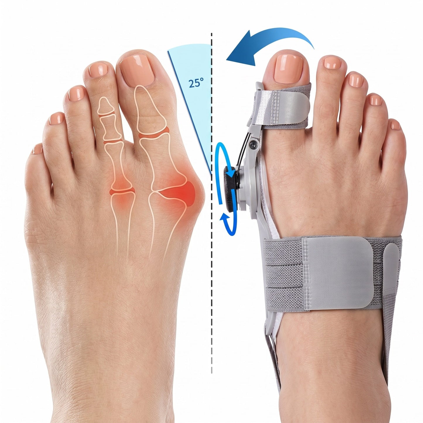 ToeAlign™ - Bunion Corrector