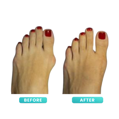 ToeAlign™ - Bunion Corrector