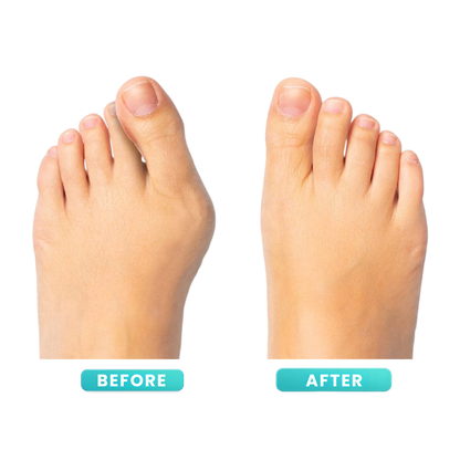 ToeAlign™ - Bunion Corrector